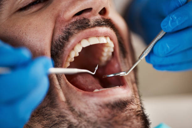Best Emergency Wisdom Teeth Removal in El Cerrito, CA